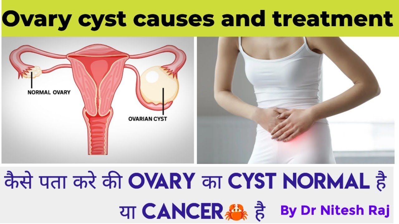 ovary cyst treatment, tumor ,cancer #drniteshraj