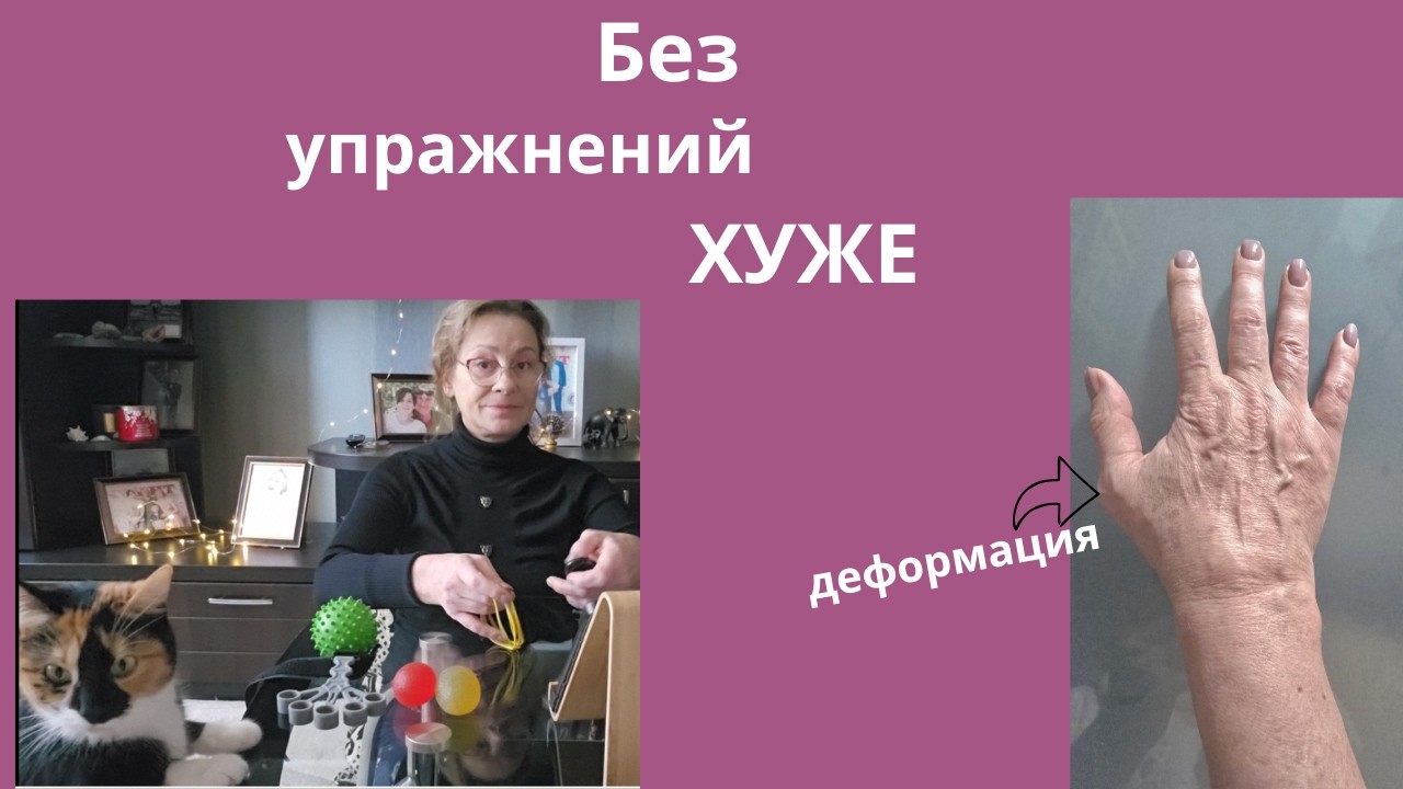 Артрит рук больше не проблема? Мой опыт#здоровыесуставы