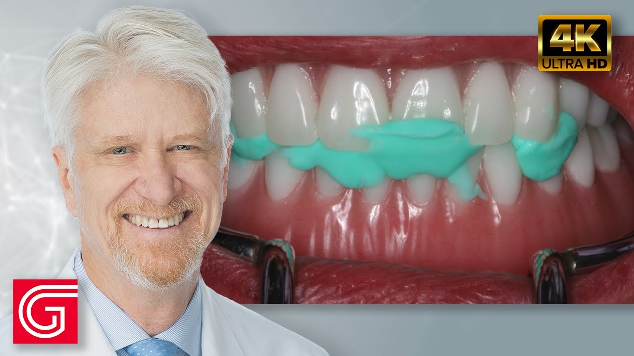 Restoration of Implant Overdentures by Timothy Kosinski, DDS, MAGD