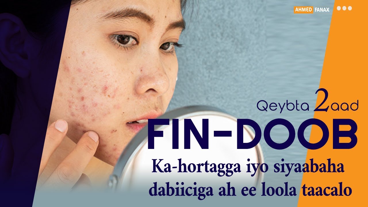 FINDOOBKA: Ka-hortagga iyo siyaabaha dabiiciga ah ee loola tacaalo!