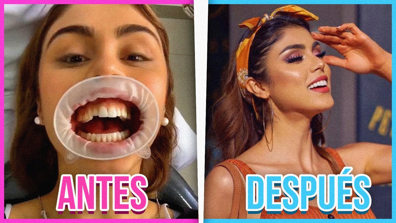 TODO SOBRE MI DISEÑO DE SONRISA! - PAUTIPS