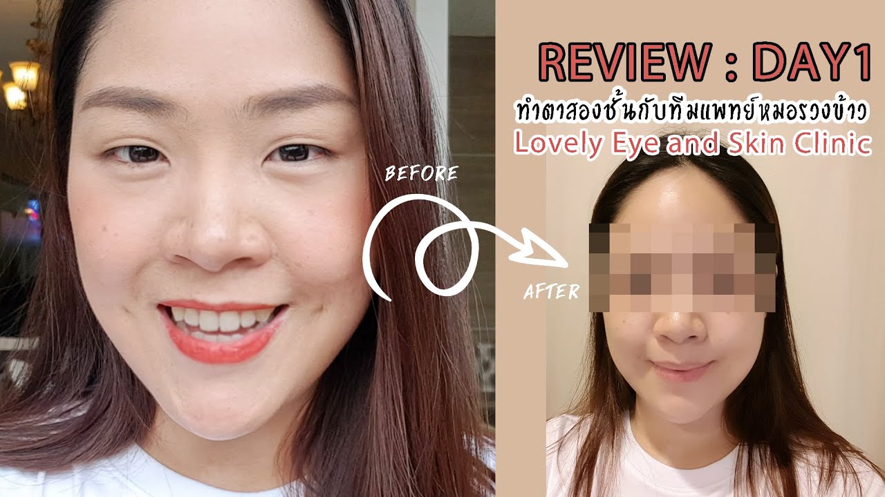 รีวิว ทำตาสองชั้นทีมแพทย์หมอรวงข้าว Lovely Eye and Skin Clinic วันที่ 1
