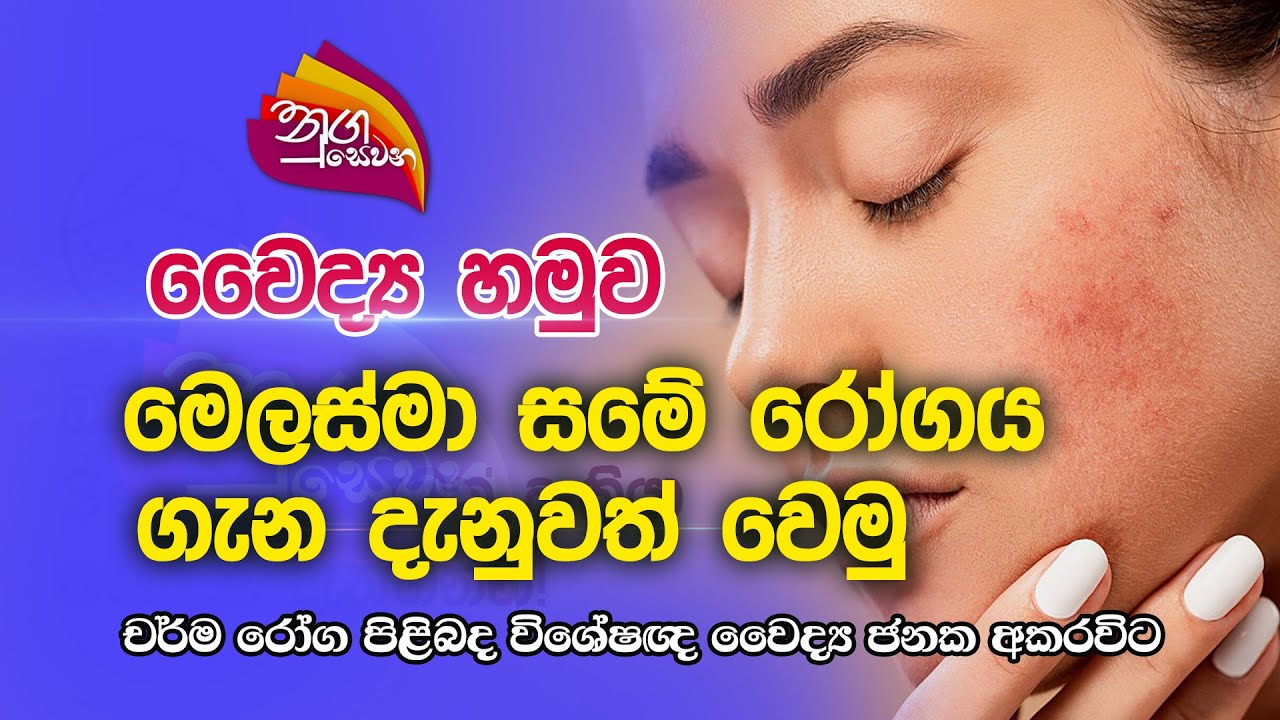 Nugasewana | වෛද්‍ය හමුව - මෙලස්මා සමේ රෝගය  ගැන දැනුවත් වෙමු | Rupavahini