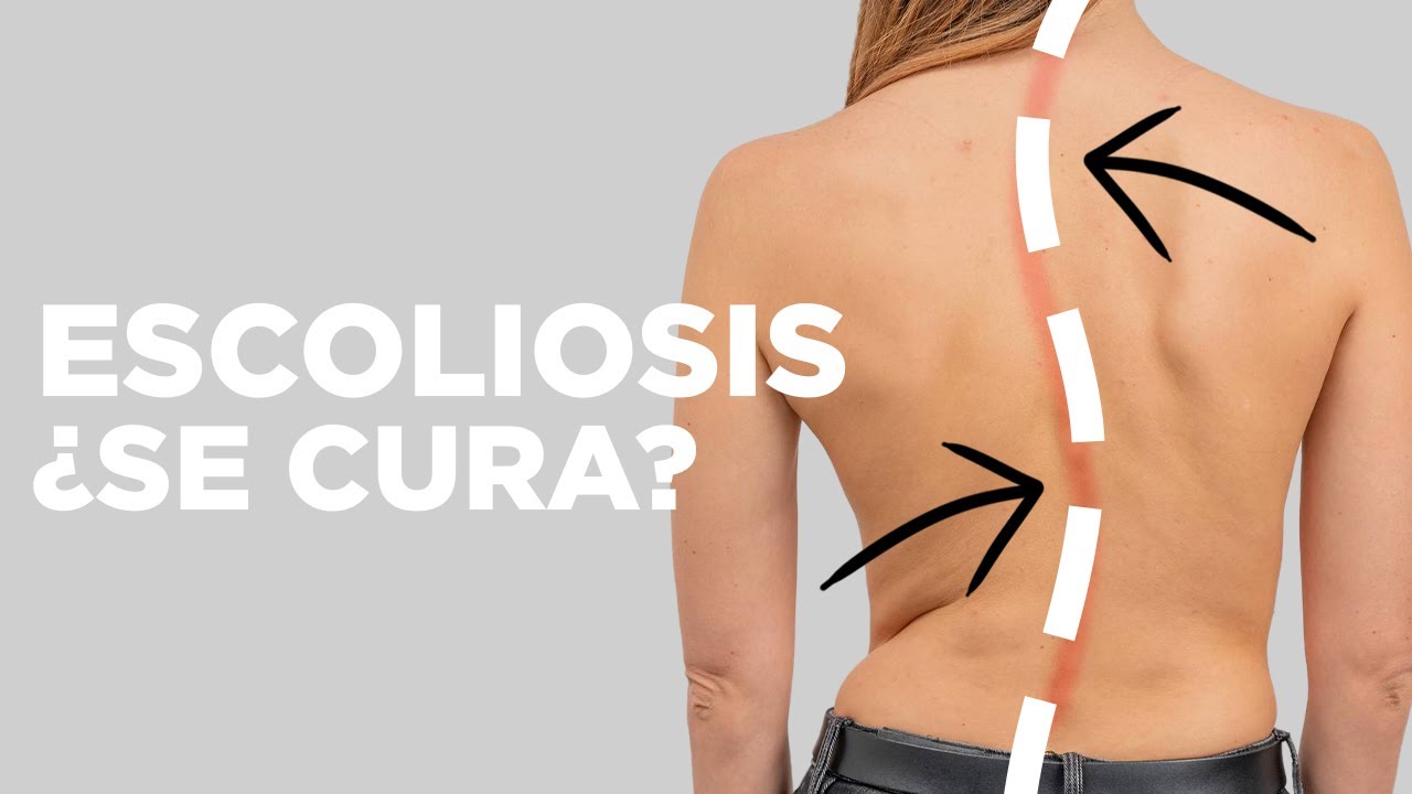 La ESCOLIOSIS ¿se CURA SOLA?