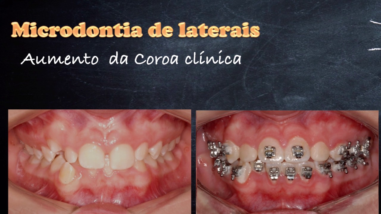 Microdontia dos laterais - Prof. Dr. Pedro Andrade Jr