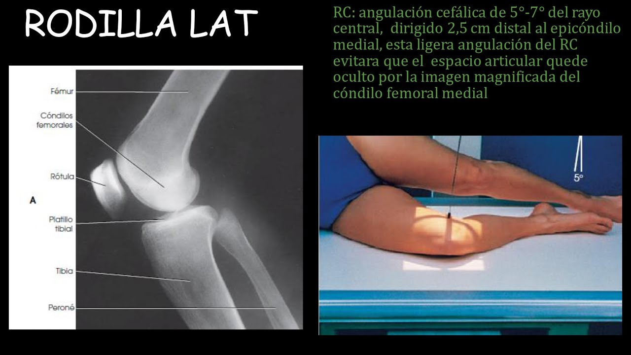 PROYECCIONES Rx, Miembros Inferiores, Escanometria y Edad Osea