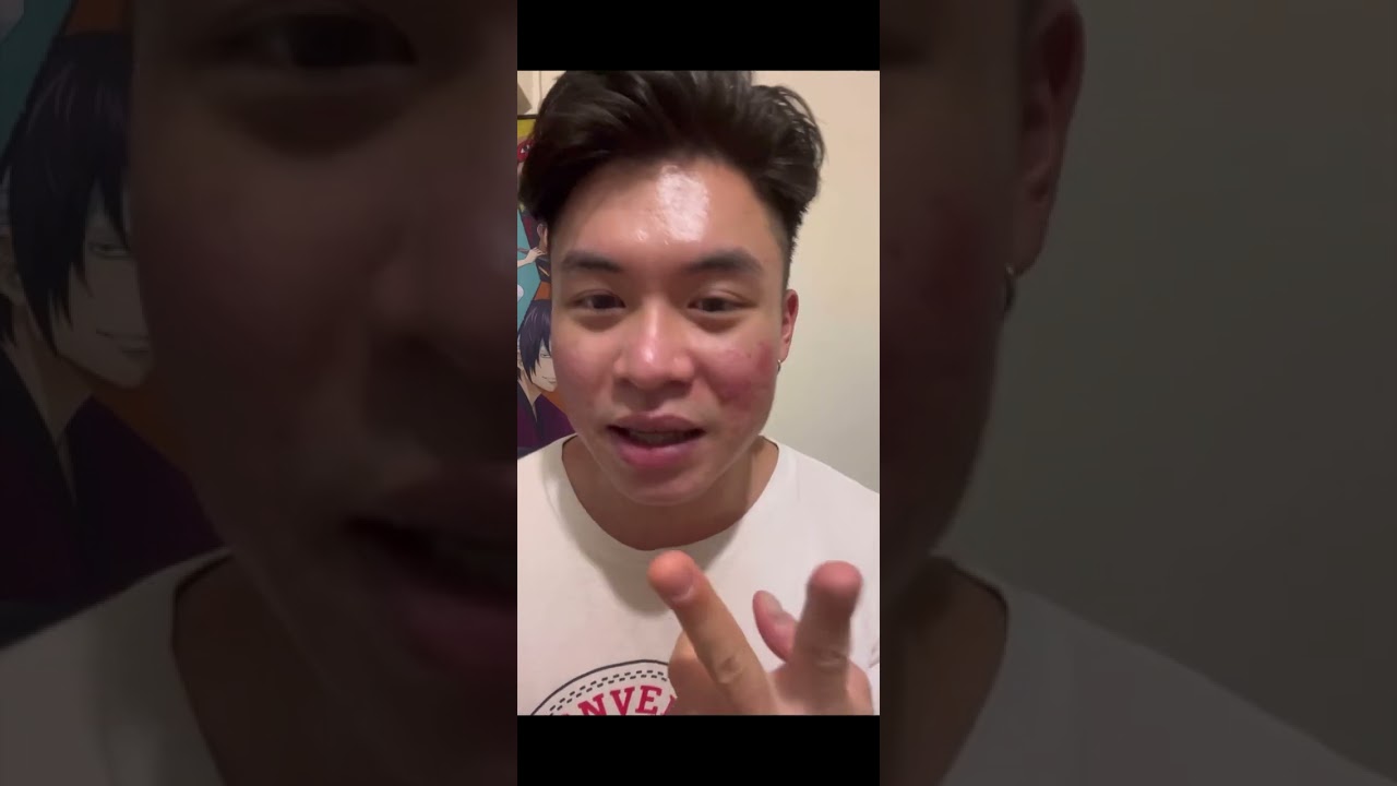 第二次機械磨皮紀錄 痘疤治療