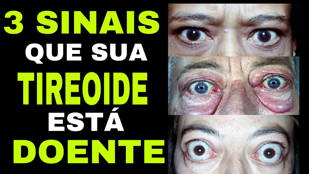 3 SINAIS NO SEU CORPO QUE A TIREOIDE ESTÁ DOENTE (Hipertireoidismo)