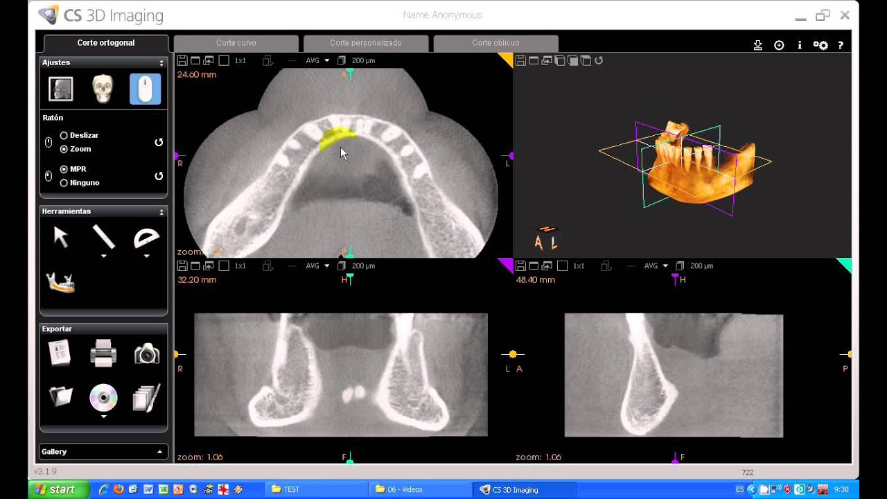 Tutorial CS 3D imaging software. Carestream. 03-Carestream. Uso de la barra de herramientas.avi