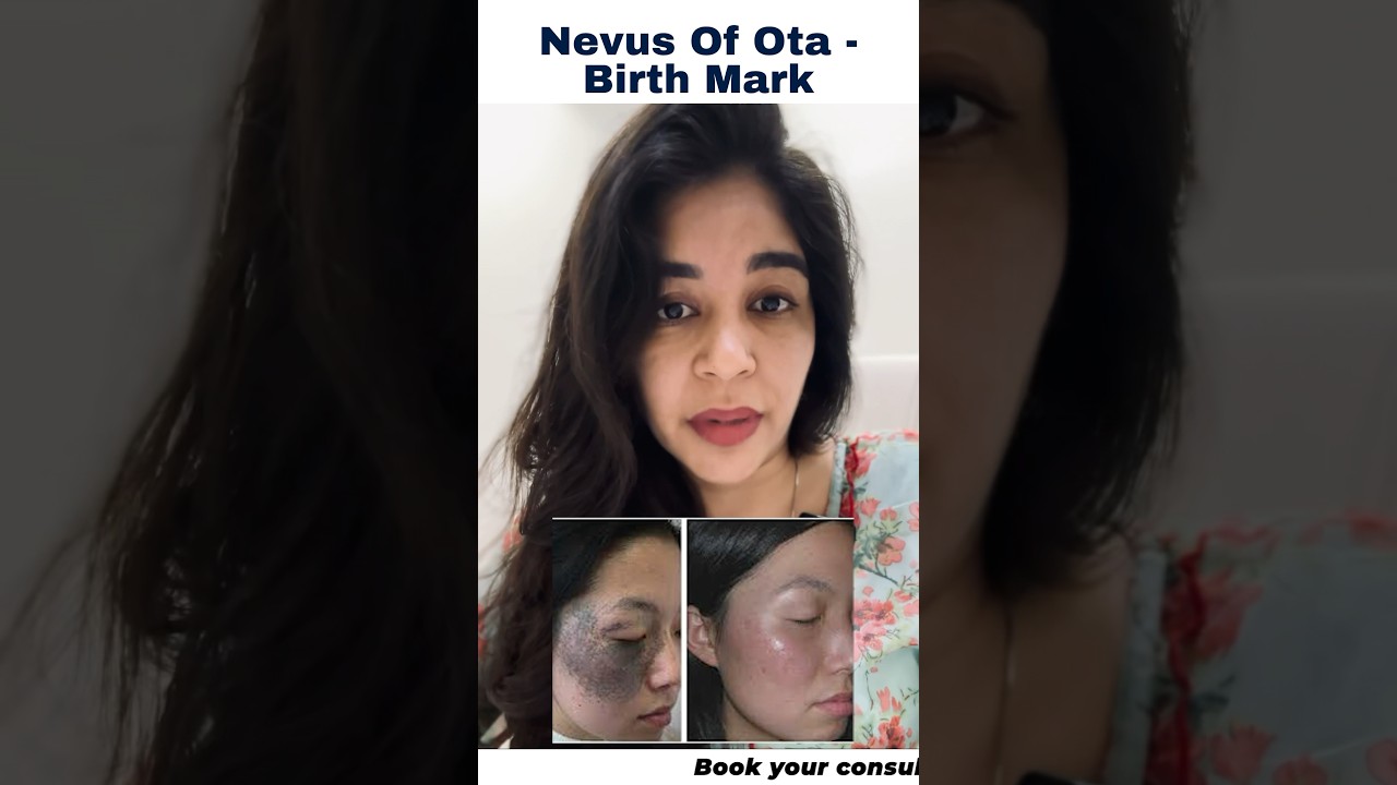 Dermatologist Dr. Anvika Reveals The Solution Of Nevus Of Ota!