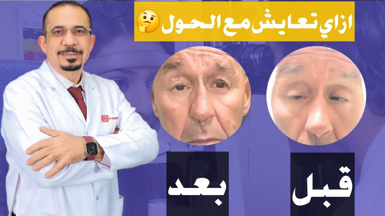 علاج الحول | رجل كان يعاني من الحول منذ الطفولة - حالة مؤثرة 😢😢