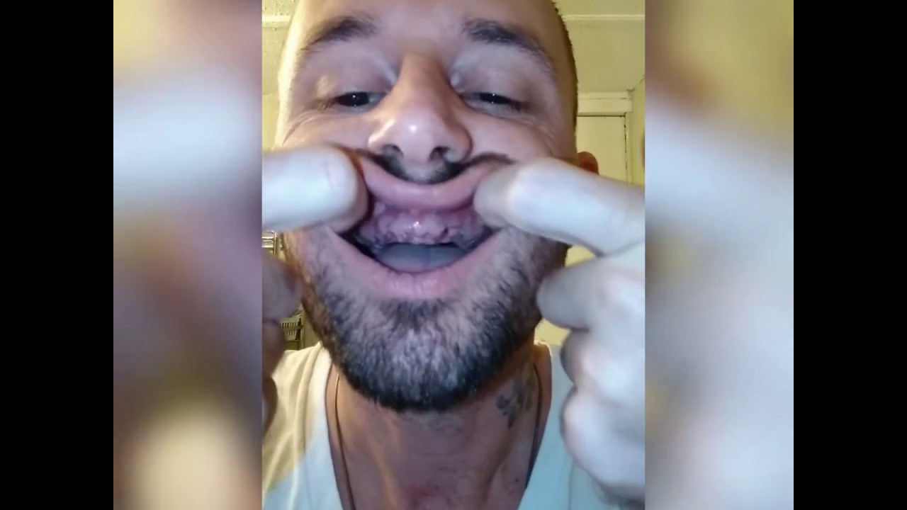 Wearing dentures Immediate dentures day 5 update and how I clean my gums.