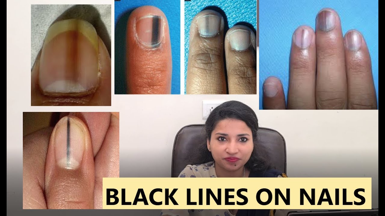 नाख़ून पे काली लाइन - क्या ये है कैंसर का लक्षण ?- MBBS MD (MAMC) (स्किन )- हिंदी २०२०