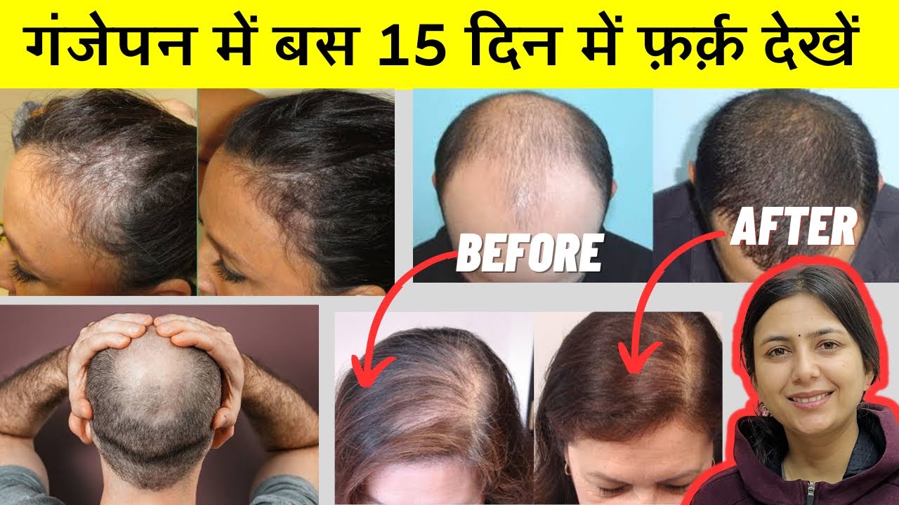 Lost Hair Growth Challenge - Fix Bald Patches, Regrow Lost Hair | Hair Growth Oil to Regrow Hair