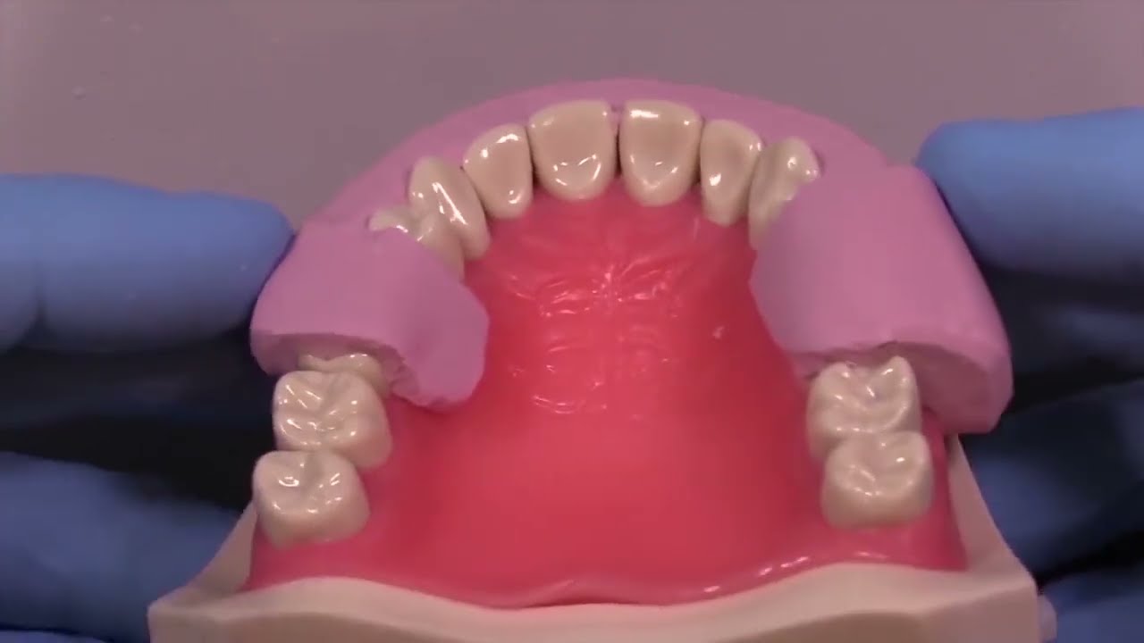 Porselen Lamina Veneer 1-  Silikon İndeks Hazırlama