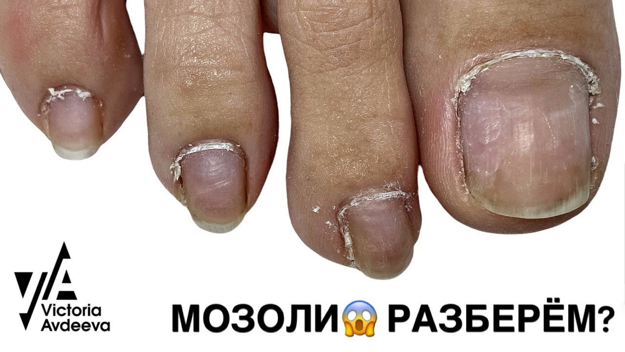КОВЫРЯЕМ МОЗОЛИ В ПРЯМОМ ЭФИРЕ.  Виктория Авдеева