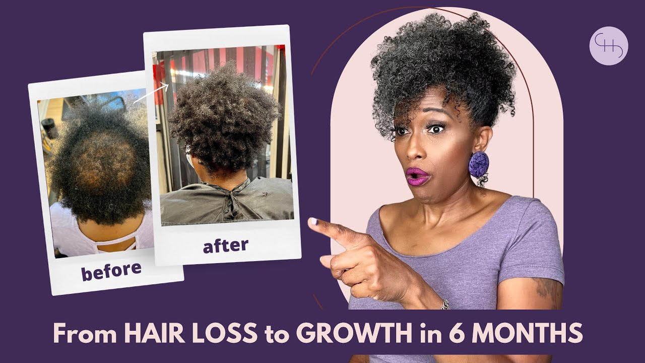 From HAIR LOSS to HAIR GROWTH in 6 MONTHS! 🙀