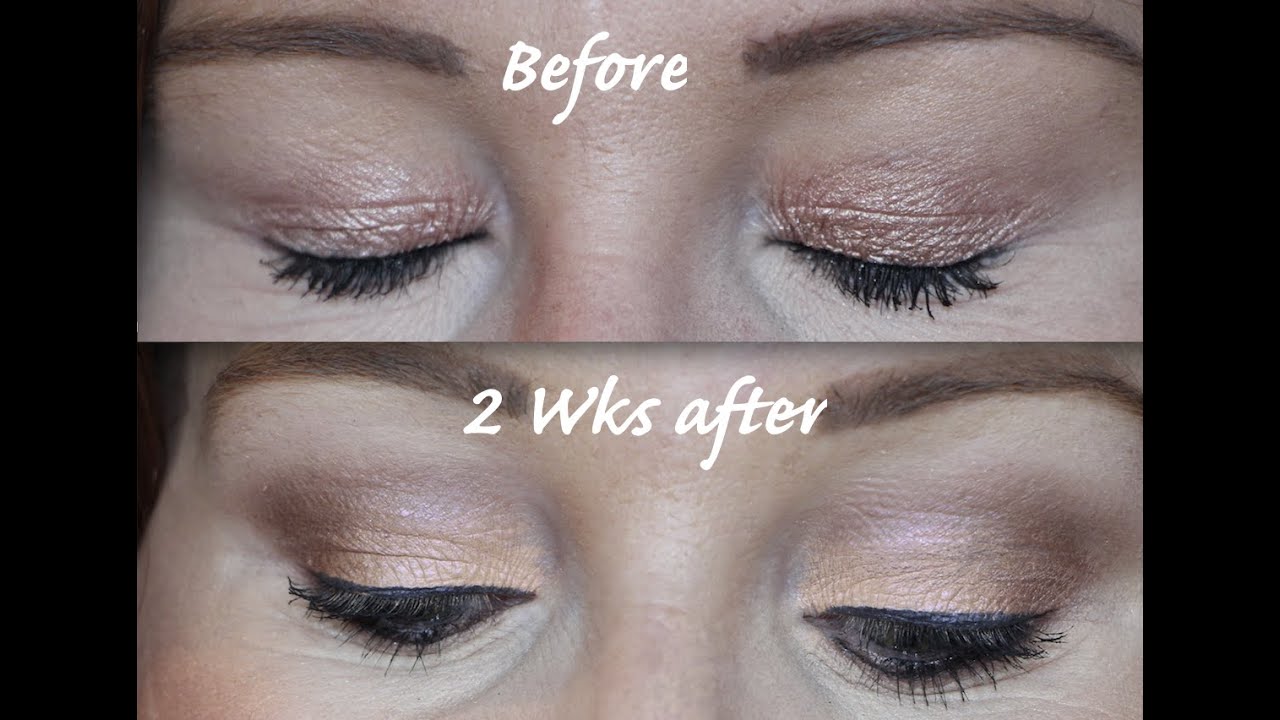 Plexr Plasma Fibroblast Hooded Eye Treatment - Part 2 - Non surgical Blepharoplasty?