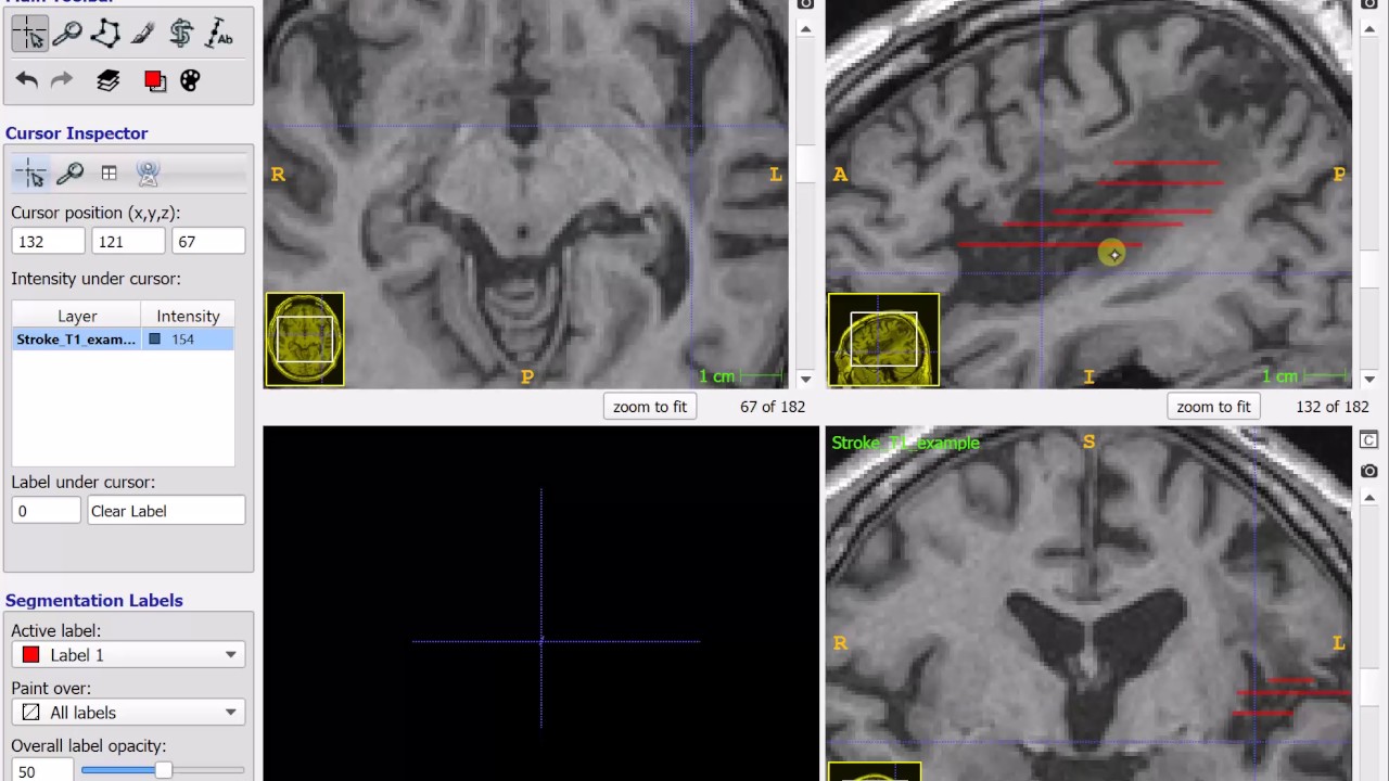 Fast manual lesion segmentation in ITKsnap