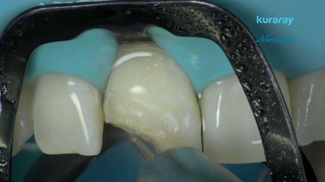 1. Preparazione dei denti - Restauro dei denti anteriori con CLEARFIL MAJESTY ES-2