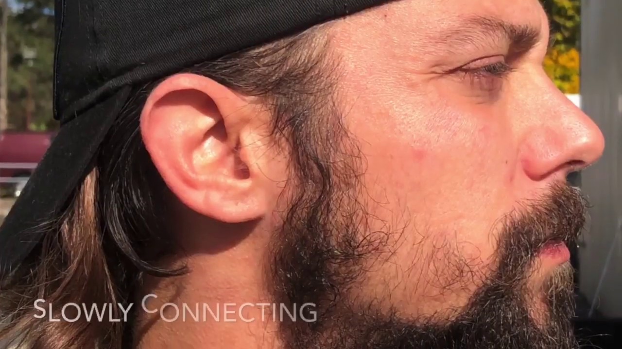 13 week growing out a patchy sparse weak cheek beard