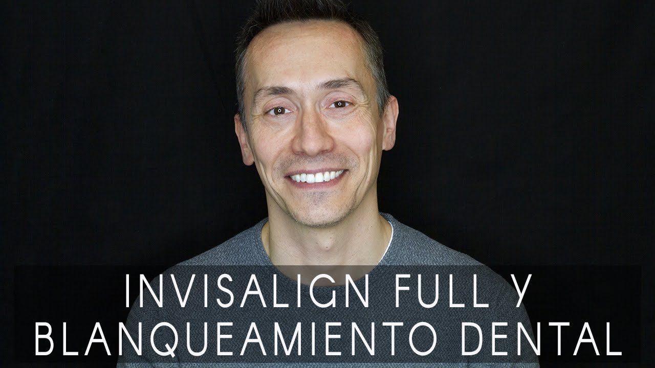 La sonrisa de Santiago: Invisalign Full y blanqueamiento dental combinado