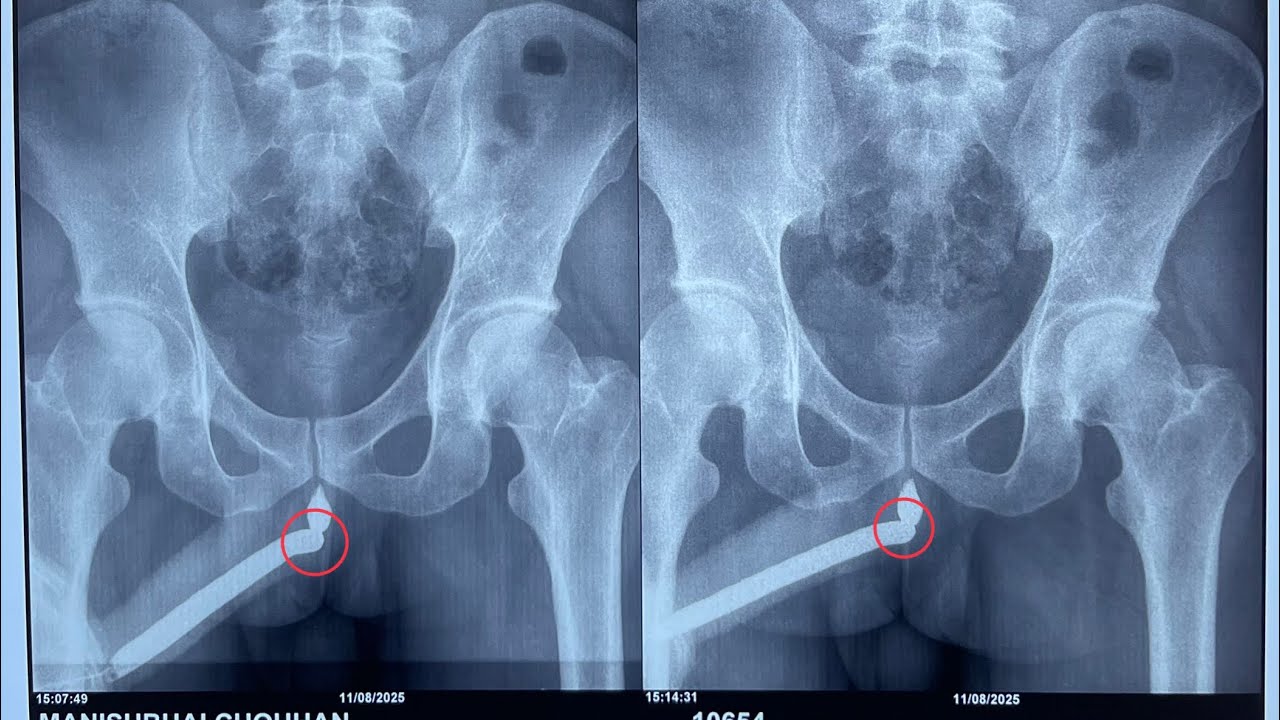 Ayurveda for Urethral Stricture | Permanent Relief Without Surgery