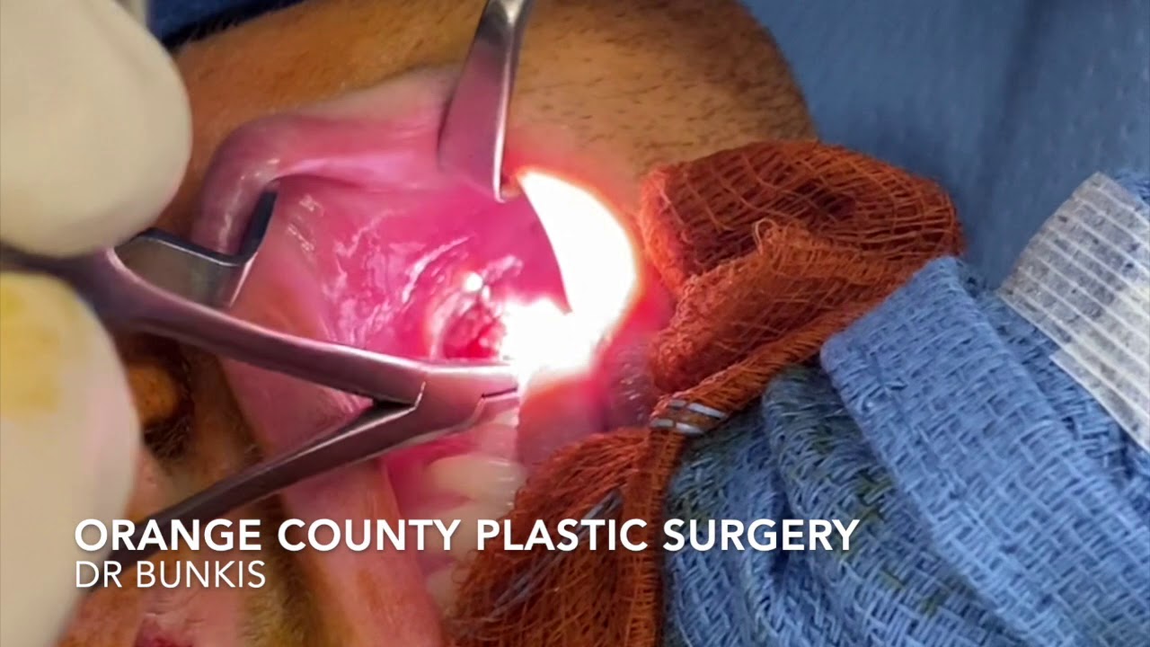 Orange County Plastic Surgery- Buccal Lipectomy