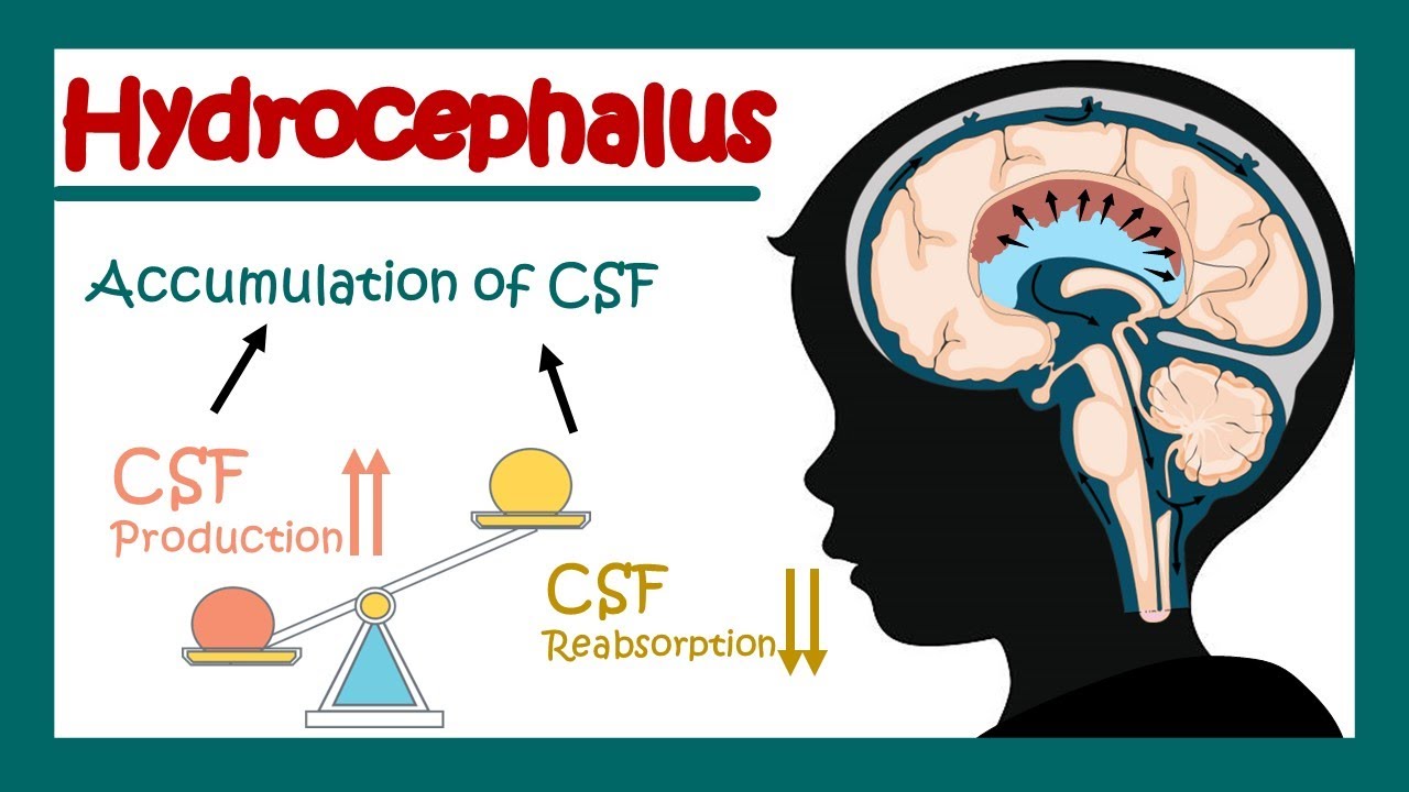 Hydrocephalus | What can cause hydrocephalus? | Communicating vs non communicating hydrocephalus