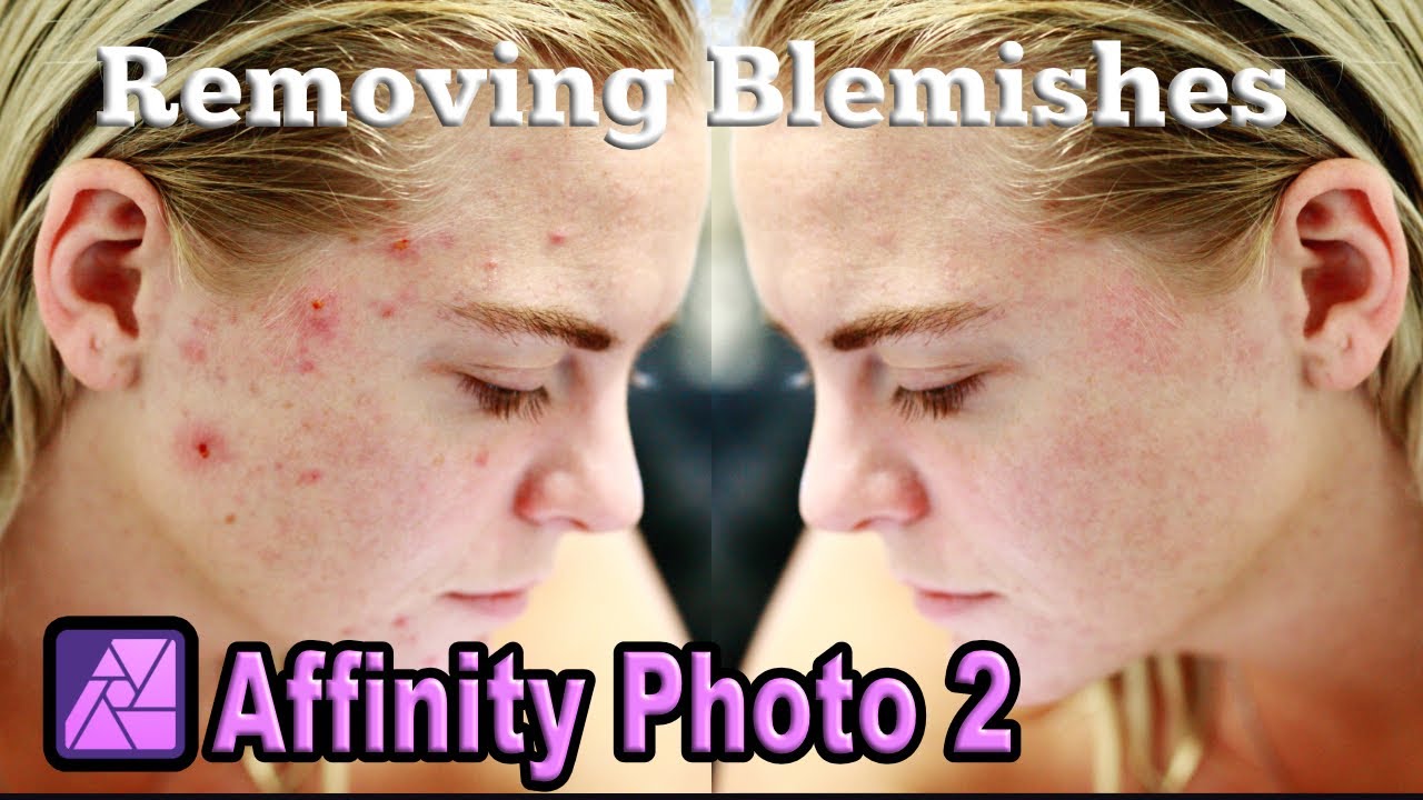 Removing Skin Blemishes in Affinity Photo 2