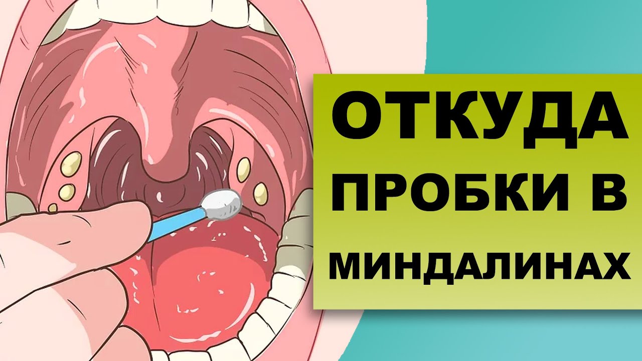 КАК УХОДЯТ ПРОБКИ ИЗ МИНДАЛИН