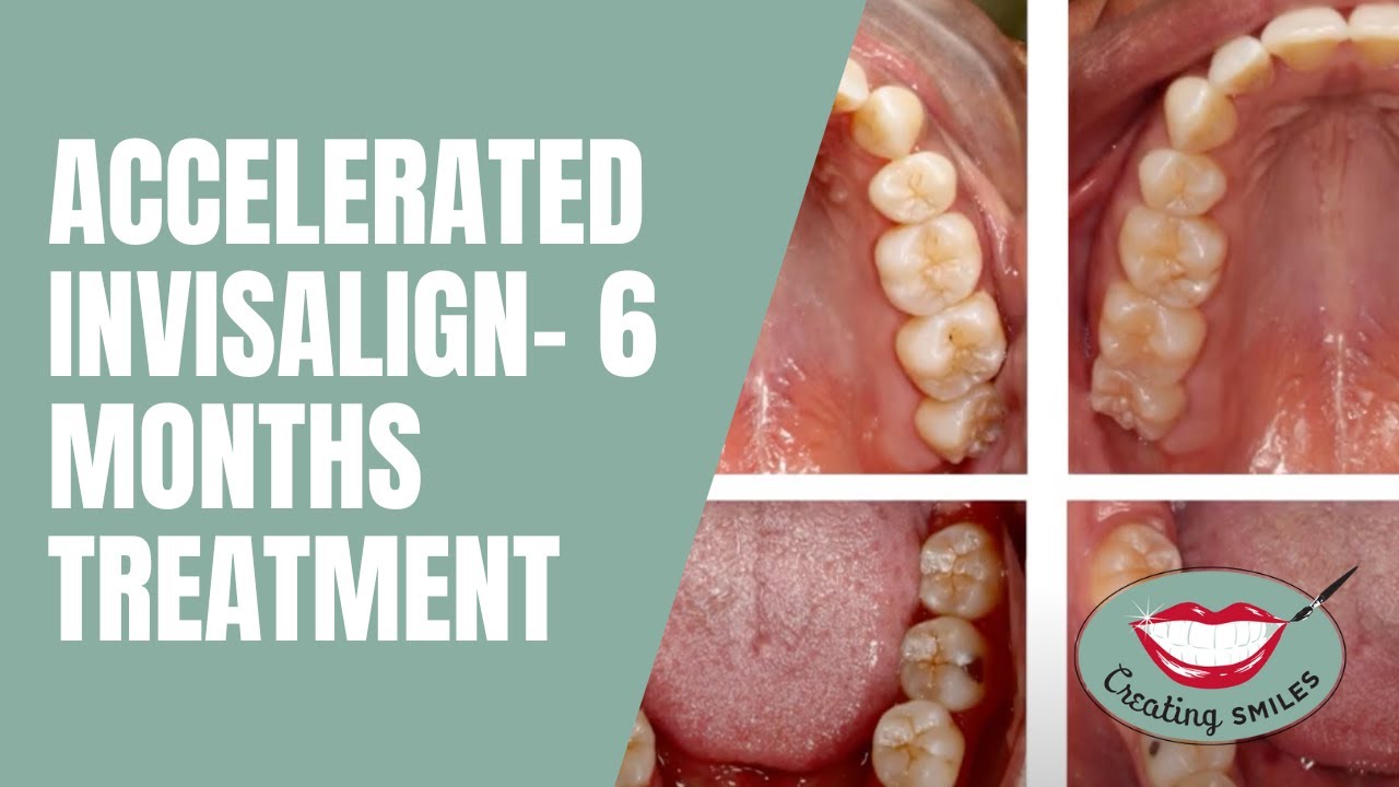 Accelerated Invisalign- 6 months Treatment | Invisalign for Teens and Adults | St. Petersburg, FL