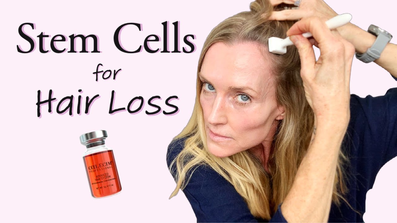 Stem Cells to STOP & REVERSE Hair Loss & Hair Thinning? | 6 week BEFORE & AFTER Calecim Hair Serum