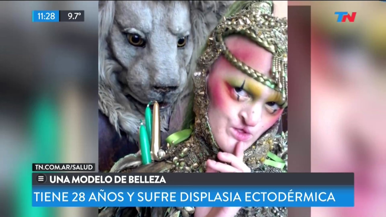 Sufre displacia ectodérmica y es una supermodelo
