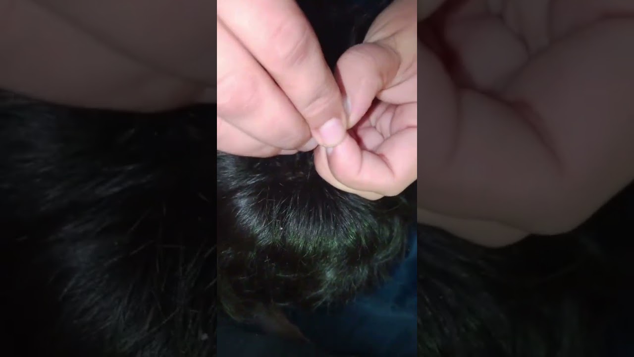 Battle of lices in  A young Boy hairs....😱🪰Hundred of nits removing process.....