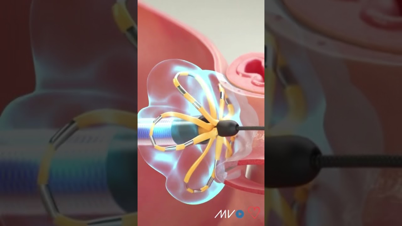 What is Pulsed Field Ablation (PFA)?