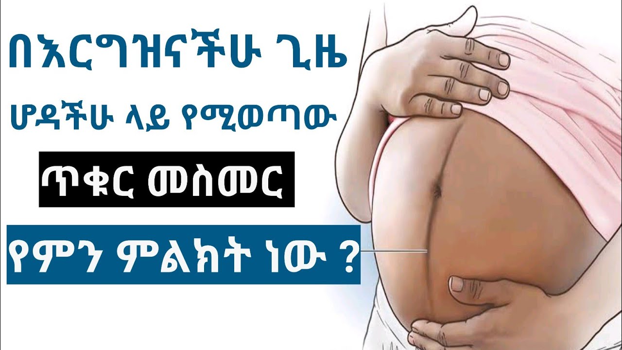 በእርግዝና ወቅት በሆዳችሁ ላይ የሚፈጠረው መስመር የምን ምልክት ነው ? | Linea Nigrea - Pregnancy line
