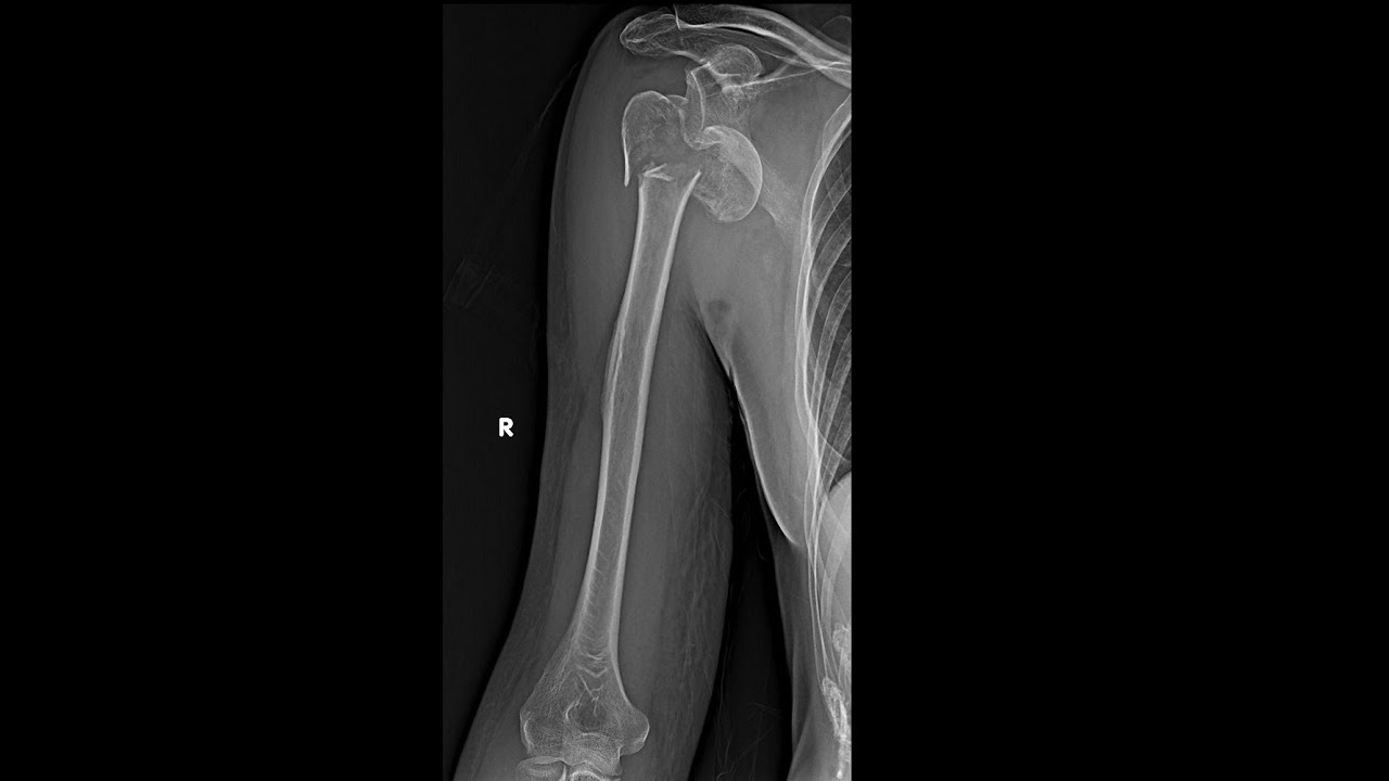Hertel's criteria for proximal humerus fractures- everything you need to know- with X--Ray examples.