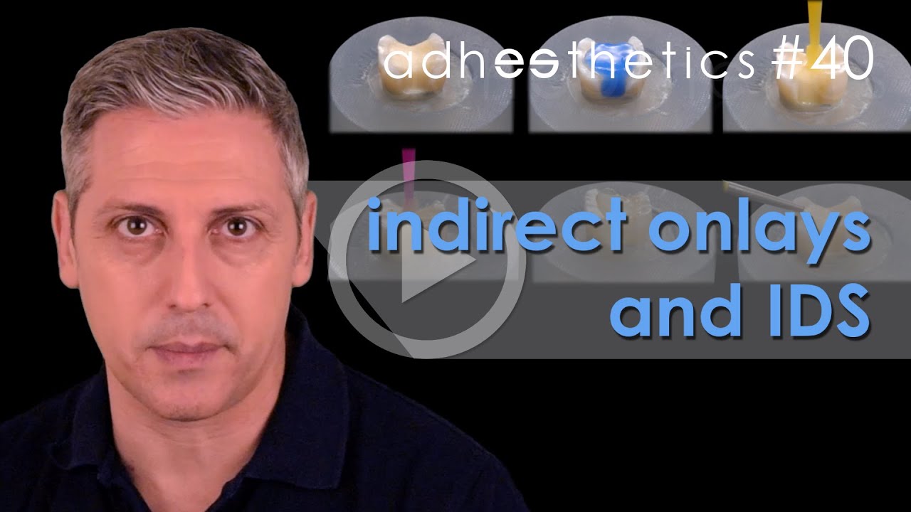 🇬🇧 Indirect onlays and IDS_short#40 ENG_Adhesthetics Protocols