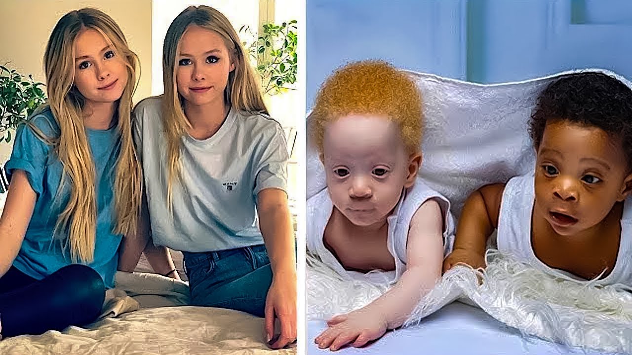10 Most Unusual Twins You Won&rsquo;t Believe Exist!