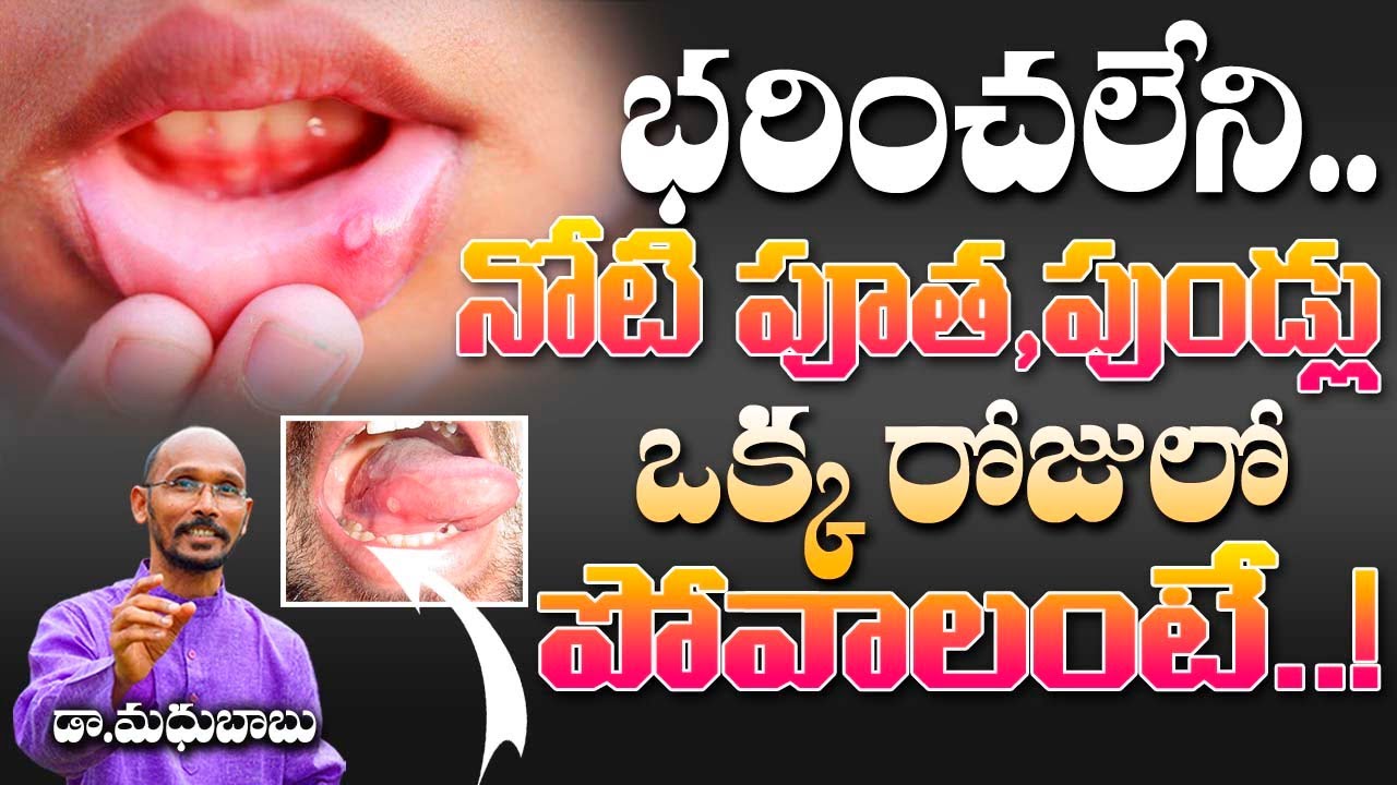 భరించలేని నోటి పూత , పుండ్లు ఒక్కరోజులో పోవాలంటే..! | Dr. Madhu Babu | Health Trends |