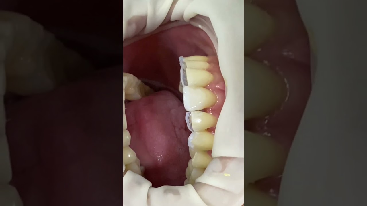 CONFIRA ESSA TRANSFORMA&Ccedil;&Atilde;O COM LENTES DE RESINA