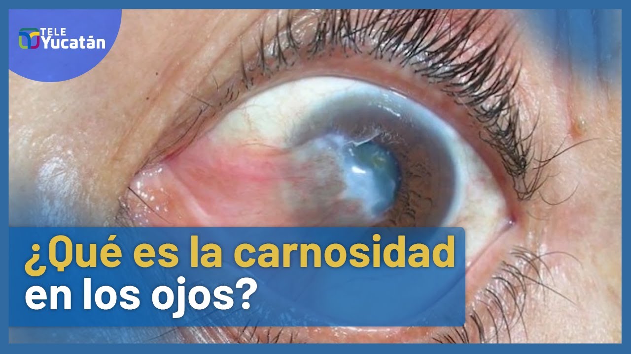 👀&iquest;Por qu&eacute; sale la carnosidad en los ojos? 🤔 |▶ 𝗧𝗘𝗡𝗘𝗠𝗢𝗦 𝗟𝗔 𝗥𝗘𝗦𝗣𝗨𝗘𝗦𝗧𝗔 | TELE Yucat&aacute;n