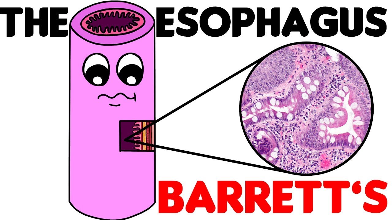 Esophagus Histology # 3: Barrett's Esophagus