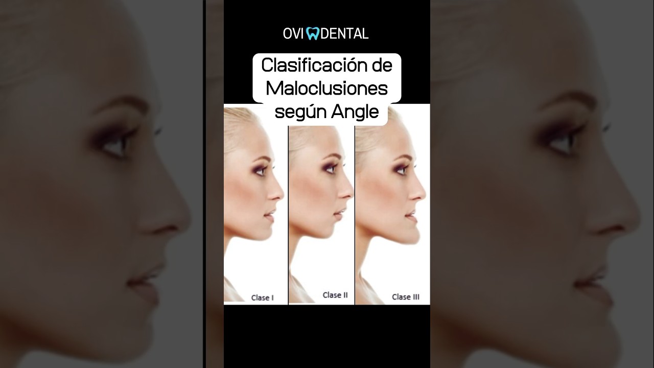 🚫 Clasificaci&oacute;n de Maloclusiones seg&uacute;n Angle #Maloclusi&oacute;nDental #Maloclusi&oacute;n #Ortodoncia #Ovidental