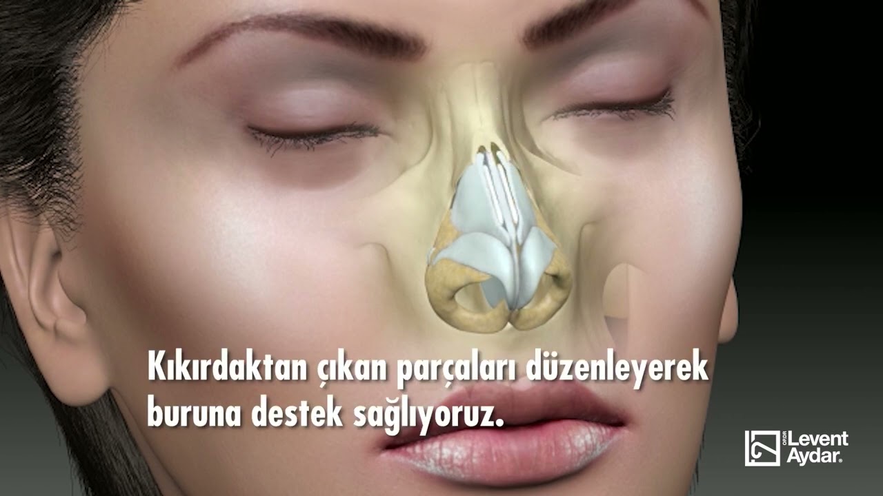 Rinoplasti ameliyatı nasıl yapılır? Rinoplasti açık burun estetiği | Op. Dr. Levent Aydar