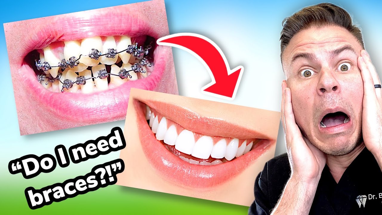 How To Tell If You Need BRACES! The ULTIMATE Braces Guide Ep. 1