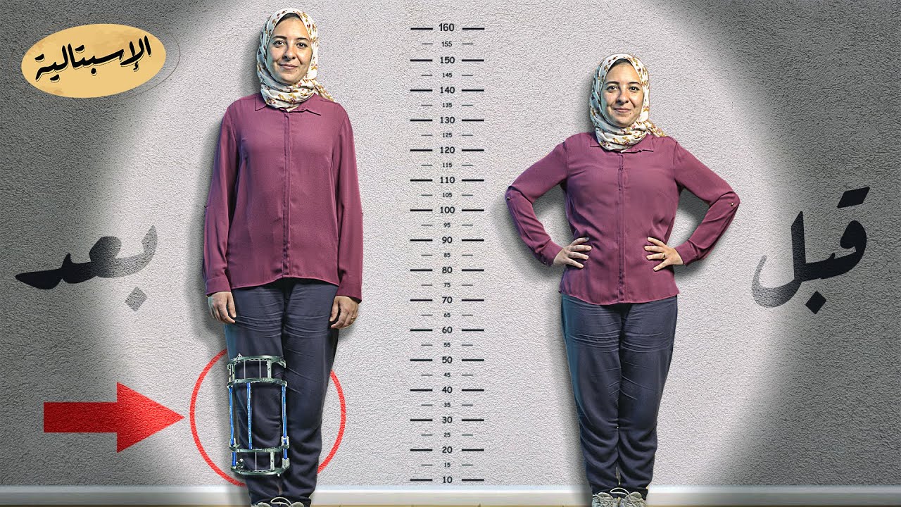 جراحة تزيد طولك ؟ | شرائح معدنية ومسامير داخل العظام ؟! 🦴🔨 | الاسبتالية