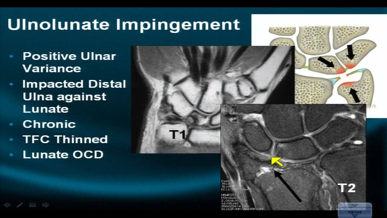 MRI Online: Wrist Part VI Evaluating Impingement Syndromes of the Wrist