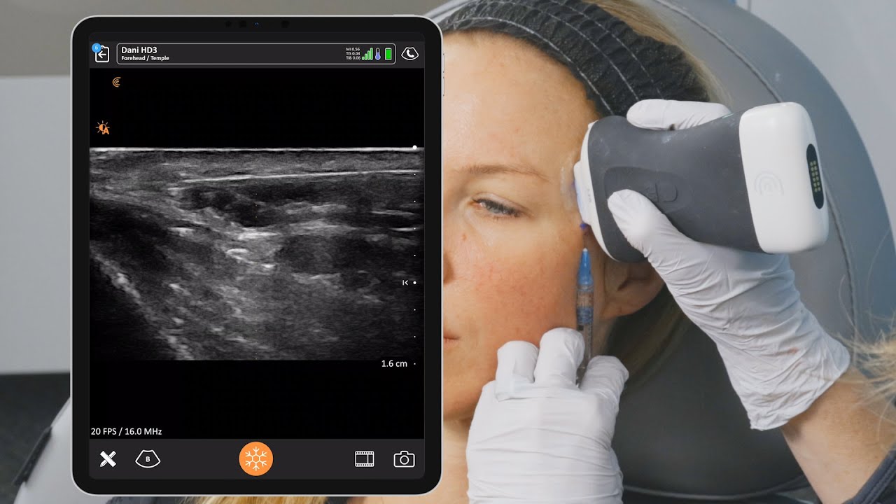 Ultrasound Guided Temple Injection Left Side